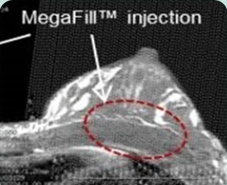 MegaFill™ injection — lateral CT image of the breast with the graft site marked