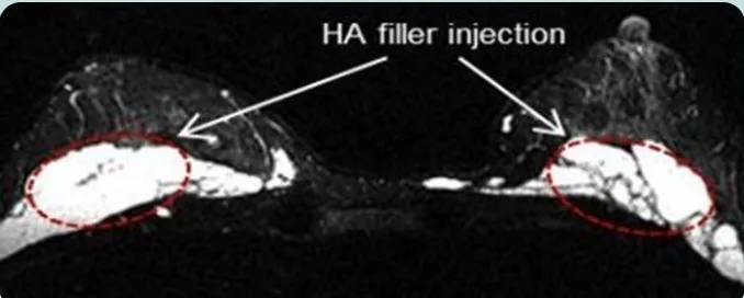 HA filler injection — axial MRI of both breasts with the filler injection sites marked