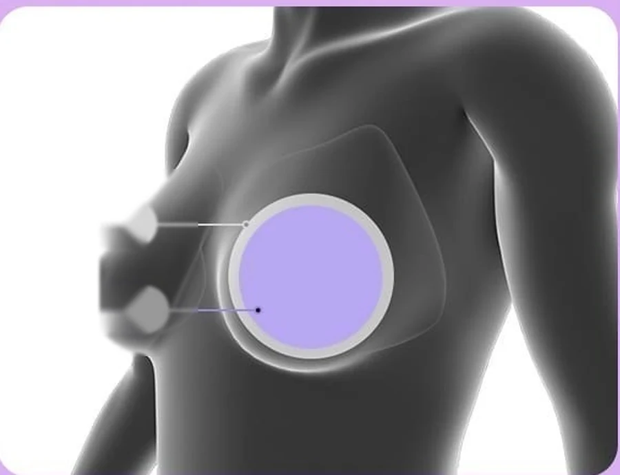 Breast cross-section diagram — the breast pocket dissected under the pectoralis major, with a round implant seated inside