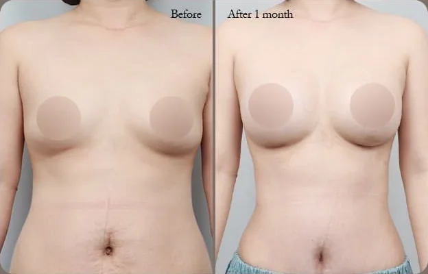 Front comparison photo 1 — before and 1 month after the breast & tummy dual lift