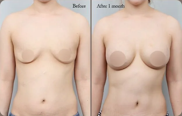 Front comparison photo 2 — before and 1 month after the breast & tummy dual lift