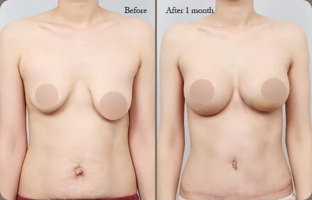Front comparison photo 3 — before and 1 month after the breast & tummy dual lift