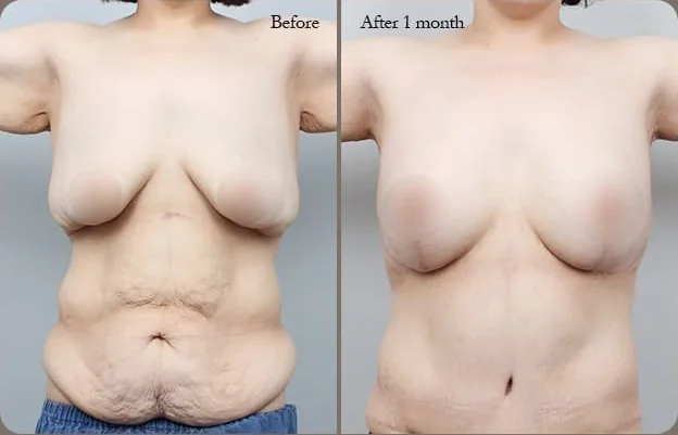 Front comparison photo 4 — before and 1 month after the breast & tummy dual lift
