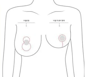 Upper-body diagram showing the vertical incision position and the post-op scar shape
