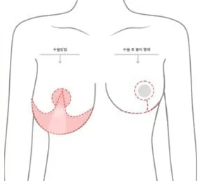 Upper-body diagram showing the O-type incision extent and the post-op scar shape