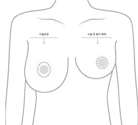 Upper-body diagram showing the areolar incision position and the post-op scar shape