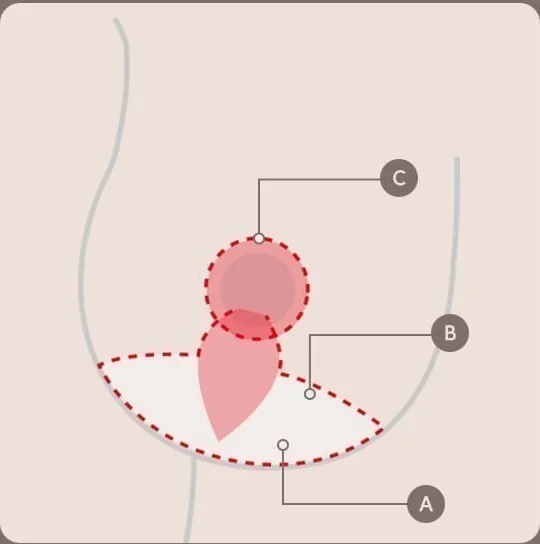 Breast lift incision design diagram — A the inframammary fold, B the side line, C around the areola