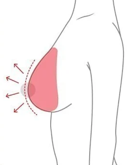 Side diagram of breast augmentation filling volume with an implant only
