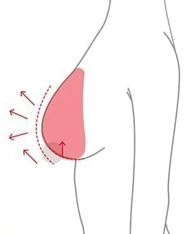 Side diagram of a breast lift raising the nipple position along with implant placement