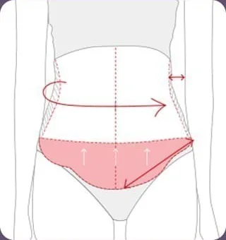 Diagram marking the abdominal surgical design and the liposuction area