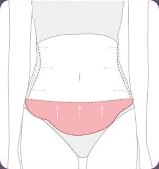 Diagram marking the area covered by full abdominal liposuction