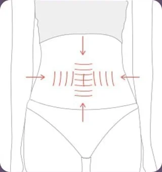 Diagram showing crosswise double abdominal muscle plication after excising the stretched skin