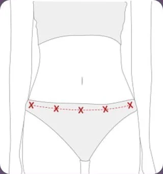 Diagram marking the suture line at pelvic-bone height inside the bikini line