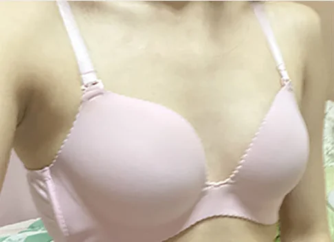 Photo before breast surgery 2