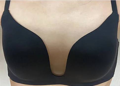Photo before breast surgery 7