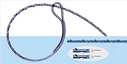 Diagram of V-Loc sutures