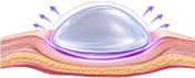 Cross-section diagram of implant placement in a dry pocket
