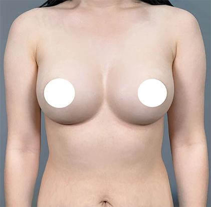After breast augmentation 1