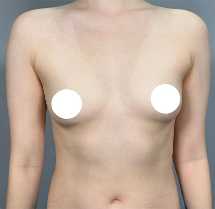 Before breast augmentation 1