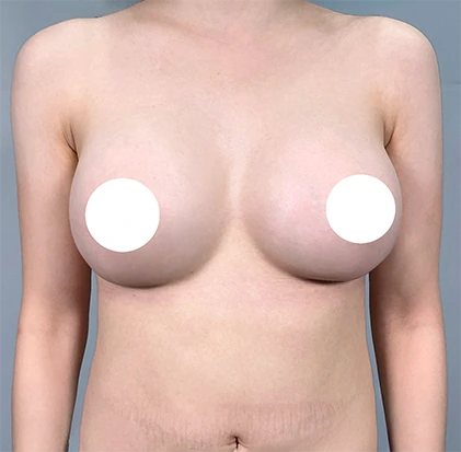 After breast augmentation 3