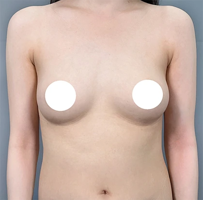 Before breast augmentation 3