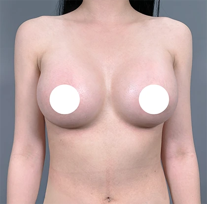 After breast augmentation 4