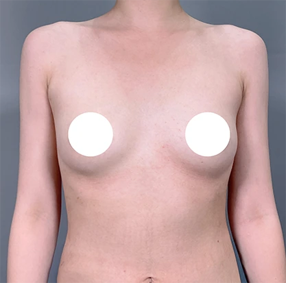 Before breast augmentation 4