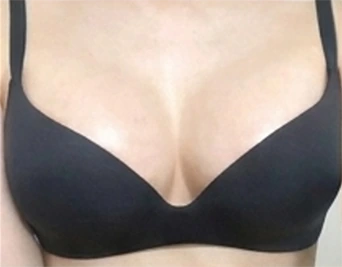 Bra fitting photo after breast augmentation 1