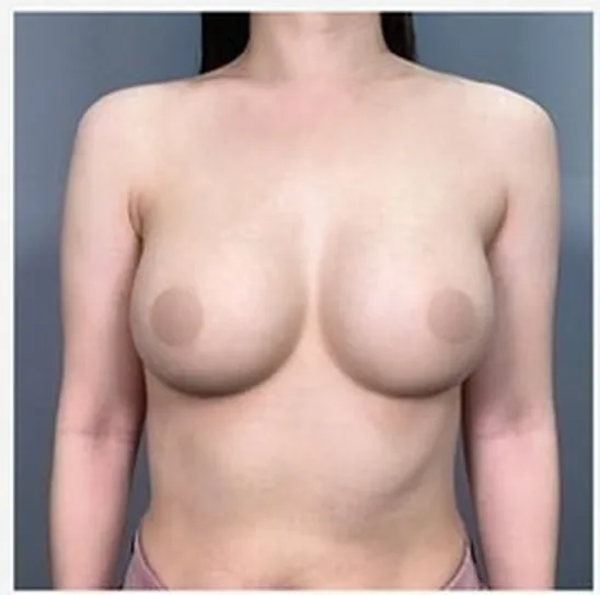 Front view after single-side breast revision, photo 1