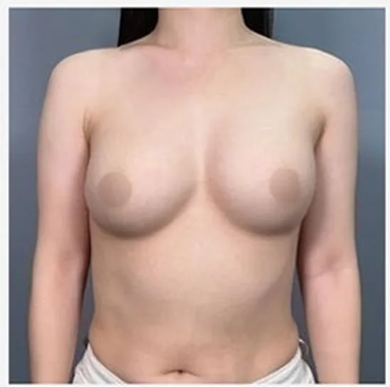 Front view before single-side breast revision, photo 1
