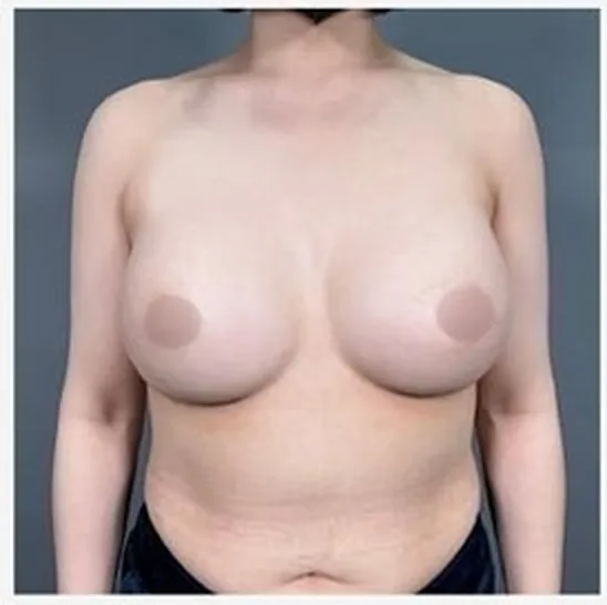 Front view after single-side breast revision, photo 2