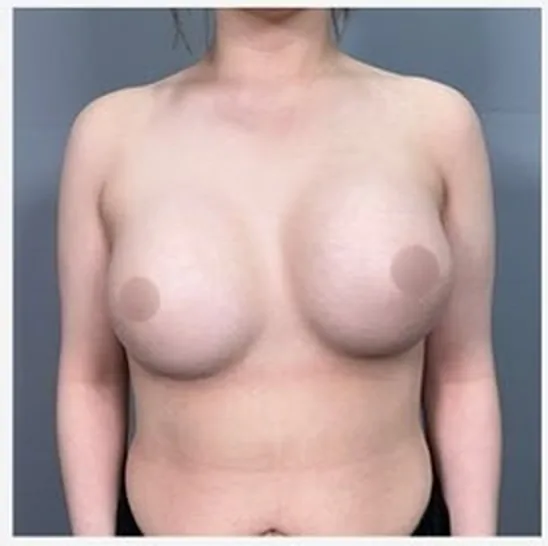 Front view before single-side breast revision, photo 2