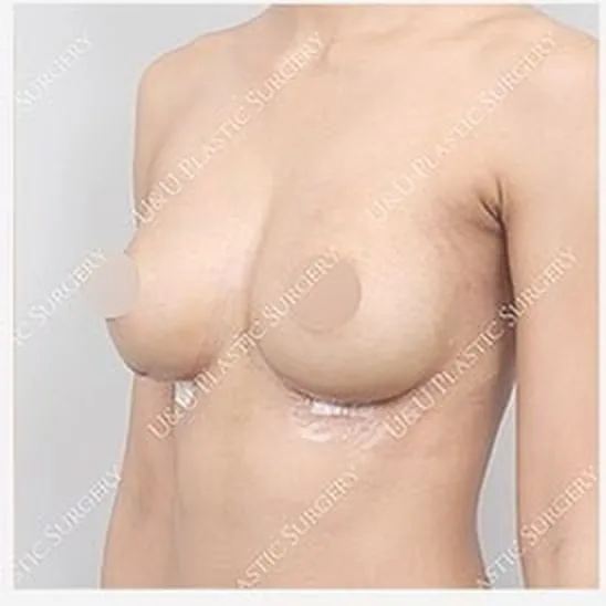Side view after single-side breast revision, photo 3