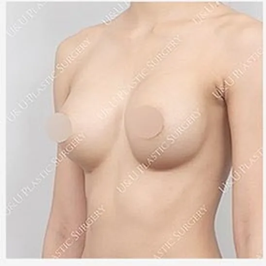 Side view before single-side breast revision, photo 3