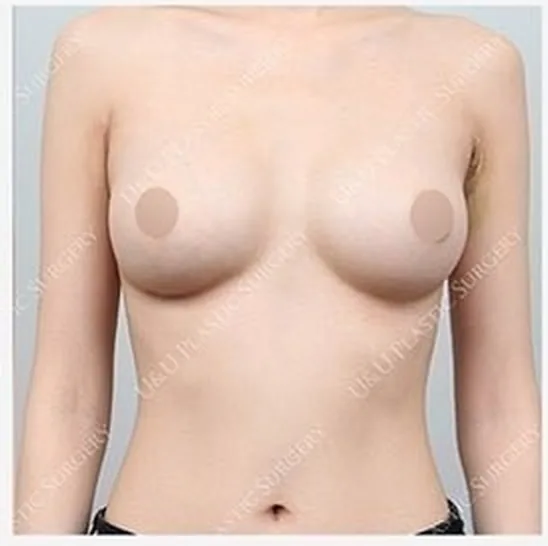 After single-side breast revision, photo 5