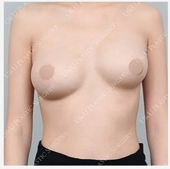 Before single-side breast revision, photo 5