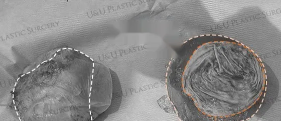 Specimen photo — the capsule removed Em Bloc laid beside the ruptured implant