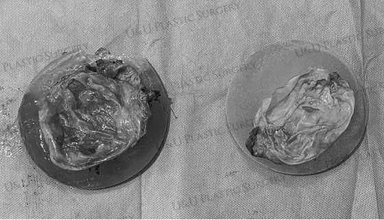 Specimen photo — the removed capsule and implant contents in a tray