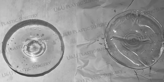 Specimen photo — two saline implants that have leaked their contents