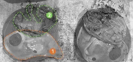 Specimen photo — a teardrop textured implant removed together with the double capsule