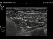 Breast ultrasound image showing extracapsular rupture