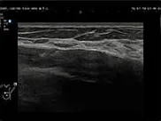 Breast ultrasound image showing intracapsular rupture