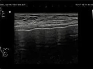 Breast ultrasound image measuring capsule thickness
