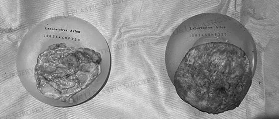 Left and right removed capsules in a tray still marked with the manufacturer label