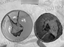 Removed capsule and implant in a clear container