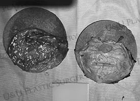 Removed capsules divided into two trays