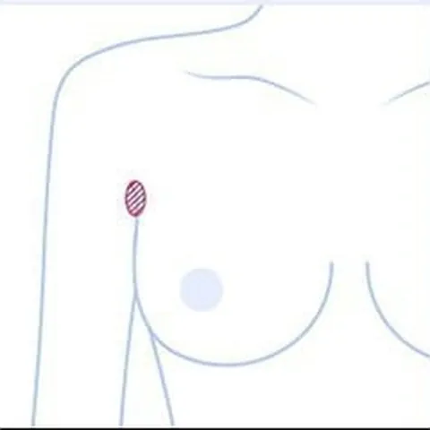 Upper-body illustration marking the axillary incision site