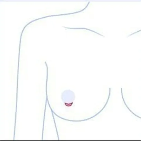 Upper-body illustration marking the areolar incision site