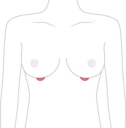 Breast surgery