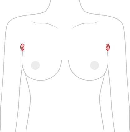 Breast surgery